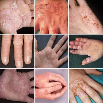 Экзема атопический дерматит симптомов кожи стоковое фото ©panxunbin 17972455