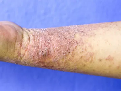 Аллергическая сыпь дерматит экзема кожи на ноге пациента. Псориаз и экзема  кожи с большими красными пятнами. Концепция здоровья стоковое фото  ©ternavskaia.o@gmail.com 200428718