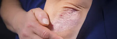 Атопический дерматит: микробиом кожи помогает! | Контент для широкой  общественности | Микробиота Институт