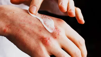 Пеленочный дерматит или опрелость кожи у малыша: что делать? Советы  дерматолога