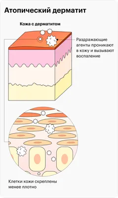 Себорейный дерматит кожи волосистой части головы ✓ Авторские статьи Клиники  подологии Полёт в Москве