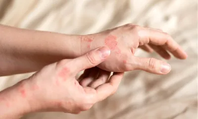 Эффективность лечения кожных заболеваний (псориаз, атопический дерматит)  кремом «КАРТАЛИН» - Kartalin - официальный представитель в Украине