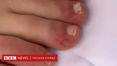 Красная сыпь на животе: симптомы и причины, что делать, прогноз