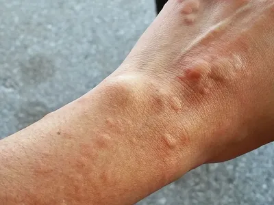 Атопический дерматит экземы на коже руки в Bluroncept обработки проблемы  аллергии, кожных заболеваний Стоковое Изображение - изображение  насчитывающей пациент, кожа: 205773207