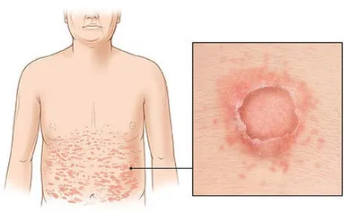 Лечение розового лишая (лишая Жибера) в Киеве — Derma.ua