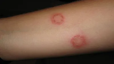 Кожные заболевания: симптомы болезней кожи, методы диагностики, часто  встречающиеся кожные заболевания
