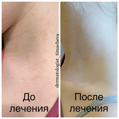 Лечение розового лишая (лишая Жибера) в Киеве — Derma.ua