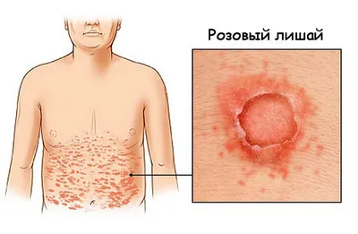 Kseniia - Розовый лишай Жибера воспалительное заболевание... | Facebook