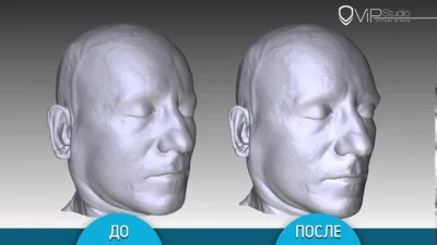 Ортопедический шлем в 3D клинике Мастер Ортопед в Казани