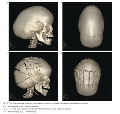 Первые дни после операции краниостеноз у ребенка. Не бойтесь, в будущем все  будет хорошо! Главное - профилактика травматизма :) | Lucky Tots | Дзен