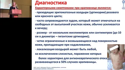 Если крапивница не вылечилась несколько месяцев, значит, ее нельзя вылечить?  -Запрещенные новости