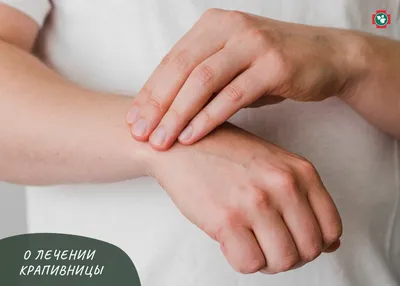 Крапивница - диагностика и лечение в частной клинике в Киеве