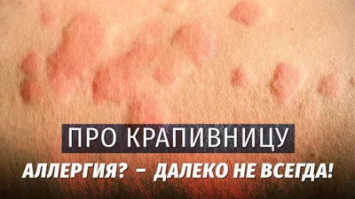 Лечение крапивницы в Московском - клиника Dr.Vita