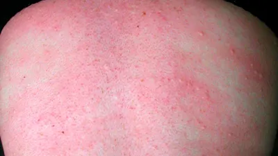 Галия Джуматаева - Аллергическая крапивница – это проявление аллергии на  коже. Такая реакция происходит из-за гиперчувствительности организма к  определённому фактору. Выделяются следующие виды крапивницы: * Острая –  реакция происходит практически ...