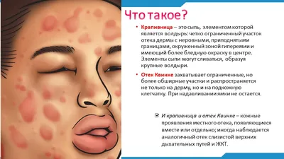 Лечение крапивницы в Московском - клиника Dr.Vita