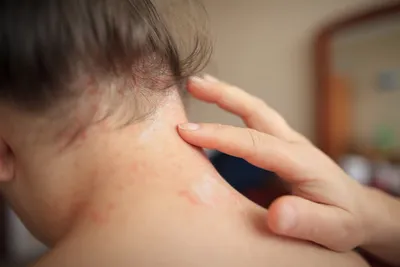 Зуд кожи головы: причины, лечение, шампунь для женщин и мужчин
