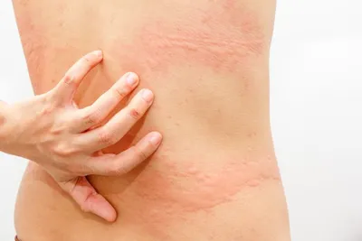 Сыпь на коже: что делать? | НаПоправку - врачи онлайн 24/7 | Дзен