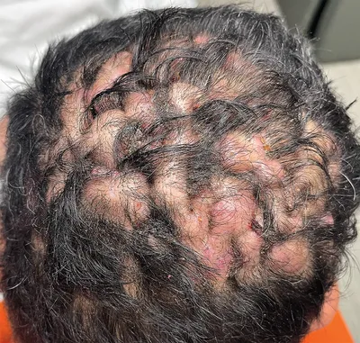 Дерматит в волосах или кожном заболевании на голове Стоковое Фото -  изображение насчитывающей скальп, проблема: 78069730