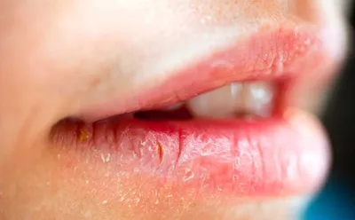 У ребенка опухла верхняя губа: 4 основные причины