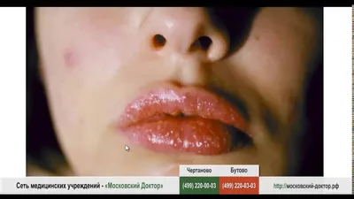 Лечение ангионевротического отёка или отёка Квинке в Москве в отделении  аллергологии клиники ИАКИ