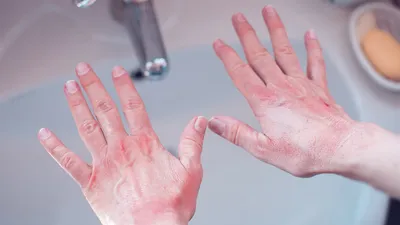 Крем Belupo для наружного применения Белодерм - «Аллергия на холод. Реакция  кожи рук на резкое похолодание. Фотографии до применения, и ежедневное  изменение кожи(все фото спрячу в цитаты, чтобы не пугать)» | отзывы
