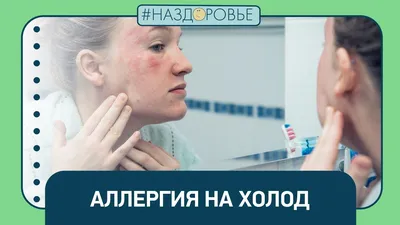 Пять минут без варежек — и крапивница. Врач из Перми рассказала об аллергии  на холод (она возникает в любом возрасте)