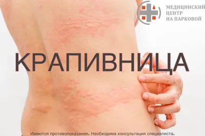 Аллергическая крапивница: причины, симптомы, диагностика и лечение |  Многопрофильный медицинский центр Воронеж