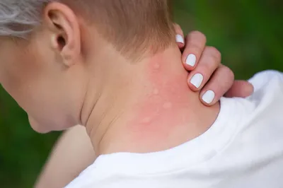Сыпь на коже, крапивница, аллергическая реакция кожи Стоковое Изображение -  изображение насчитывающей аллергически, преданности: 93000601