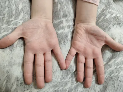 Сыпь на кистях рук у детей: возможные причины и что с этим делать –  отвечает педиатр? | О детском здоровье: с врачебного на родительский | Дзен
