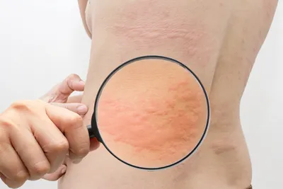 Аллергия на ладонях: причины и возможные объяснения сыпи и зуда