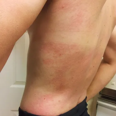 Аллергия на коже - BrizerWP