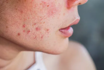 На лице сыпь: причины появления, заболевания и аллергические и угревые  высыпания на коже, лечение