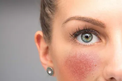 Аллергия Сыпь На Лице — стоковые фотографии и другие картинки Болезни кожи  - Болезни кожи, Азия, Аллергия - iStock