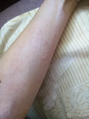 Нервная аллергия: «Муля, не нервируй меня!» | WOMAN
