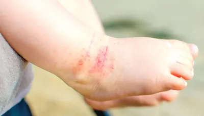 Аллергическая сыпь на ноге, кожа Азии Стоковое Фото - изображение  насчитывающей кожа, красно: 86167674