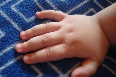 Сыпь на кистях рук у детей: возможные причины и что с этим делать –  отвечает педиатр? | О детском здоровье: с врачебного на родительский | Дзен