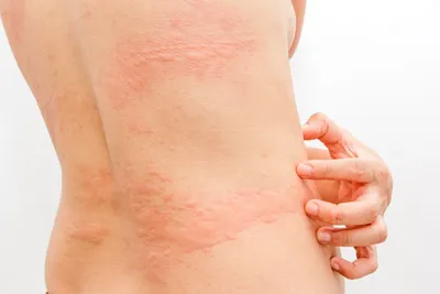 аллергия красная зудная сыпь на мужских руках на белом столе. кожный  симптом кожной проблемы пациента. закрыть снимок Стоковое Изображение -  изображение насчитывающей иносказательных, здорово: 248405691