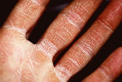 Красная сыпь на руках, вызванные аллергией Стоковое Изображение -  изображение насчитывающей взорвать, сух: 192318037