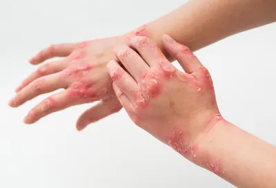 Уход за руками в домашних условиях - «Подробный отзыв о лечение холодового  дерматита на руках с помощью питания, витаминов и косметических средств.  Какая взаимосвязь между дисбактериозом кишечника и болячками с зудом на