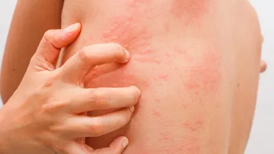 Профилактика и лечение солнечного дерматита