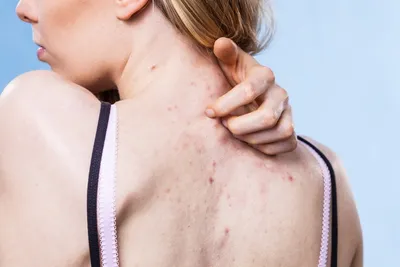 Сыпь на спине: причины, симптомы, лечение | Аллергия на спине