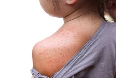 Красная сыпь на спине Аллергия кожи очень сложно лечить и занимает много  времени Стоковое Фото - изображение насчитывающей время, доктор: 197881796