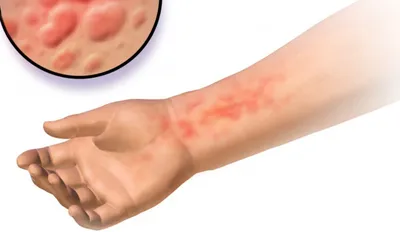 Аллергический дерматит на коже спины женщины. болезнь кожи. нейродермит,  экзема или аллергическая сыпь. здравоохранение и медицина. | Премиум Фото