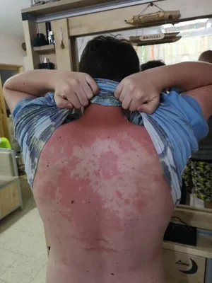 Женщина царапает спину зудом аллергической сыпью стоковое фото ©Anetlanda  166582056
