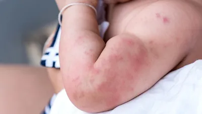 Сыпь на теле ребенка – в чем причины? Как определить аллергию, инфекции,  дерматиты | О детском здоровье: с врачебного на родительский | Дзен