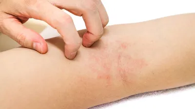 Аллергический васкулит кожи: симптомы, диагностика, лечение аллергического  васкулита кожи - Аллергология и иммунология – Государственная больница НКЦ  №2 (ЦКБ РАН)