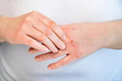 Холодовая аллергия. Что это и как ухаживать за кожей. - блог Cleo Line