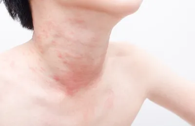 Зловещие признаки того, что у вас аллергия на холод: не простое покраснение