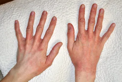 Крем Belupo для наружного применения Белодерм - «Аллергия на холод. Реакция  кожи рук на резкое похолодание. Фотографии до применения, и ежедневное  изменение кожи(все фото спрячу в цитаты, чтобы не пугать)» | отзывы
