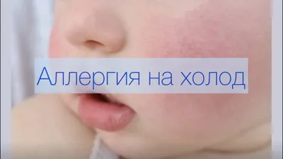 Аллергия на холод - основные симптомы и как лечить | РБК Украина